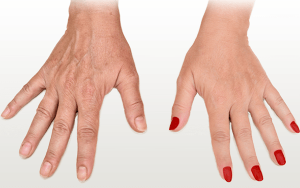 Hand Rejuvenation With PRP