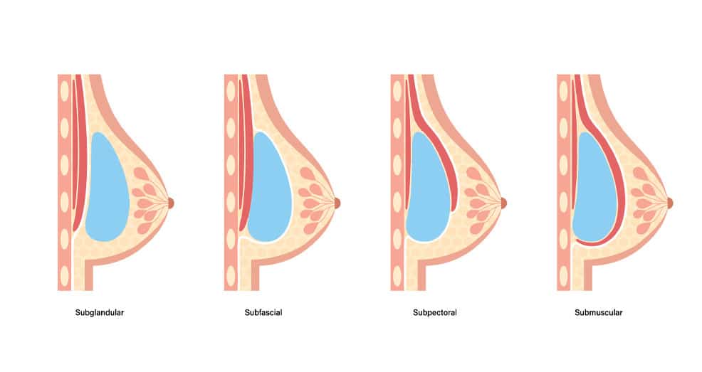 breast implant placement - Dubai